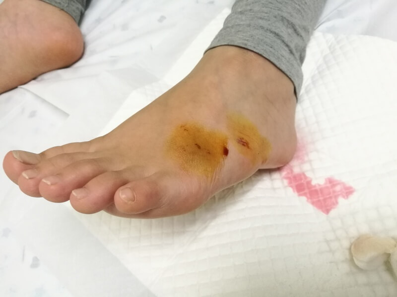 Rabies - digigit haiwan rabies